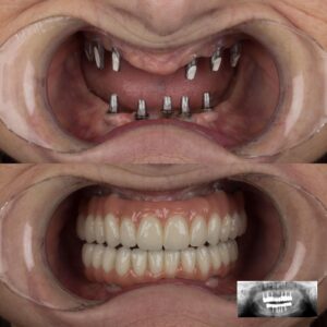 6-Implants-on-Upper-Jaw-5-Implants-on-Lower-Jaw