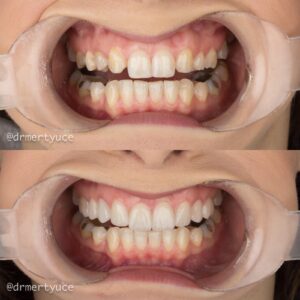 8-Emax-veneers