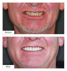 dental-implant-procedure