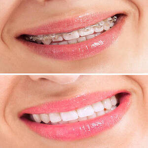 Perfect teeth before and after braces close up