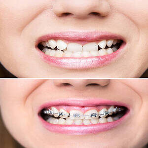 Young woman smiling before and after putting braces, dental procedure